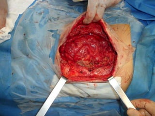 Caso clínico: Nutrición enteral en fístula enteroatmosférica de alto débito con laparostomía