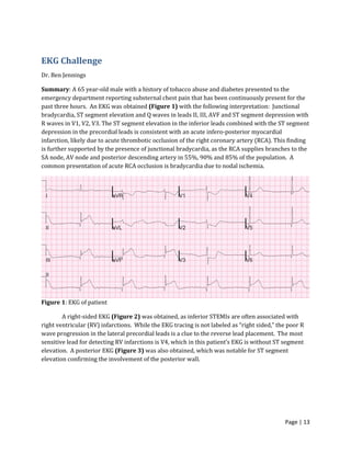 Page | 13
EKG Challenge
Dr. Ben Jennings
Summary: A 65 year-old male with a history of tobacco abuse and diabetes presented to the
emergency department reporting substernal chest pain that has been continuously present for the
past three hours. An EKG was obtained (Figure 1) with the following interpretation: Junctional
bradycardia, ST segment elevation and Q waves in leads II, III, AVF and ST segment depression with
R waves in V1, V2, V3. The ST segment elevation in the inferior leads combined with the ST segment
depression in the precordial leads is consistent with an acute infero-posterior myocardial
infarction, likely due to acute thrombotic occlusion of the right coronary artery (RCA). This finding
is further supported by the presence of junctional bradycardia, as the RCA supplies branches to the
SA node, AV node and posterior descending artery in 55%, 90% and 85% of the population. A
common presentation of acute RCA occlusion is bradycardia due to nodal ischemia.
Figure 1: EKG of patient
A right-sided EKG (Figure 2) was obtained, as inferior STEMIs are often associated with
right ventricular (RV) infarctions. While the EKG tracing is not labeled as “right sided,” the poor R
wave progression in the lateral precordial leads is a clue to the reverse lead placement. The most
sensitive lead for detecting RV infarctions is V4, which in this patient’s EKG is without ST segment
elevation. A posterior EKG (Figure 3) was also obtained, which was notable for ST segment
elevation confirming the involvement of the posterior wall.
 