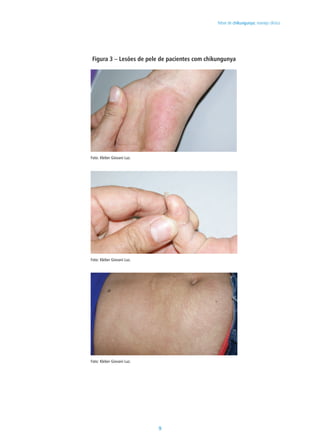 9
Febre de chikungunya: manejo clínico
Figura 3 – Lesões de pele de pacientes com chikungunya
Foto: Kleber Giovani Luz.
Foto: Kleber Giovani Luz.
Foto: Kleber Giovani Luz.
 