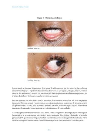 10
Secretaria de Vigilância em Saúde
Figura 4 – Outras manifestações
Foto: Kleber Giovani Luz.
Foto: Kleber Giovani Luz.
Outros sinais e sintomas descritos na fase aguda de chikungunya são dor retro-ocular, calafrios,
conjuntivite (Figura 4 – hiperemia da conjuntiva observado na fase aguda), faringite, náusea, vômitos,
diarreia, dor abdominal e neurite. As manifestações do trato gastrointestinal são mais presentes nas
crianças. Pode haver linfoadenomegalias cervicais associadas.
Para os neonatos de mães infectadas há um risco de trasmissão vertical de até 49% no período
intraparto. O recém-nascido é assintomático nos primeiros dias, com surgimento de sintomas a partir
do quarto dia (3 a 7 dias), que incluem a presença de febre, síndrome álgica, recusa da mamada,
exantemas, descamação, hiperpigmentação cutânea e edema de extremidades.
As formas graves são frequentes nesta faixa etária, como o surgimento de complicações neurológicas,
hemorrágicas e acometimento miocárdico (amiocardiopatia hipertrófica, disfunção ventricular,
pericardite). Os quadros neurológicos, também reconhecidos como sinal de gravidade nesta faixa etária,
incluem meningoencefalites, edema cerebral, hemorragia intracrania, convulsões e encefalopatias.
 