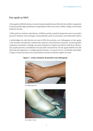 7
Febre de chikungunya: manejo clínico
Fase aguda ou febril
A fase aguda ou febril da doença é caracterizada principalmente por febre de início súbito e surgimento
de intensa poliartralgia, geralmente acompanhada de dores nas costas, cefaleia e fadiga, com duração
média de sete dias.
A febre pode ser contínua, intermitente, ou bifásica; porém a queda de temperatura não é associada à
piora dos sintomas como na dengue. Ocasionalmente, pode ser associada a uma bradicardia relativa.
A poliartralgia tem sido descrita em mais de 90% dos pacientes com chikungunya na fase aguda.
A dor articular normalmente é poliarticular, simétrica, mas pode haver assimetria. Acomete grandes
e pequenas articulações e abrange com maior frequência as regiões mais distais. Pode haver edema, e
este, quando presente, normalmente está associado à tenossinovite. Na fase aguda também tem sido
observado dor ligamentar. A mialgia quando presente é, em geral, de leve a moderada intensidade.
A Figura 2 ilustra pacientes com acometimento articular em diversas regiões do corpo.
Figura 2 – Lesões articulares de pacientes com chikungunya
Foto: Kleber Giovani Luz.
Foto: Iracilda C.S. Pinto.
 