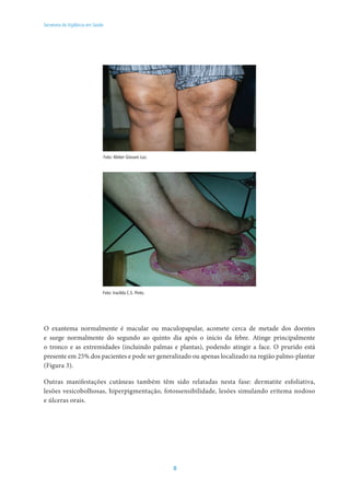 8
Secretaria de Vigilância em Saúde
Foto: Kleber Giovani Luz.
Foto: Iracilda C.S. Pinto.
O exantema normalmente é macular ou maculopapular, acomete cerca de metade dos doentes
e surge normalmente do segundo ao quinto dia após o início da febre. Atinge principalmente
o tronco e as extremidades (incluindo palmas e plantas), podendo atingir a face. O prurido está
presente em 25% dos pacientes e pode ser generalizado ou apenas localizado na região palmo-plantar
(Figura 3).
Outras manifestações cutâneas também têm sido relatadas nesta fase: dermatite esfoliativa,
lesões vesicobolhosas, hiperpigmentação, fotossensibilidade, lesões simulando eritema nodoso
e úlceras orais.
 