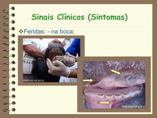 Sinais Clínicos (Sintomas)
Feridas: - na boca;
 