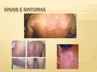 SINAIS E SINTOMAS 
 