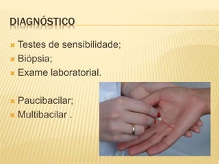 DIAGNÓSTICO 
 Testes de sensibilidade; 
 Biópsia; 
 Exame laboratorial. 
 Paucibacilar; 
 Multibacilar . 
 