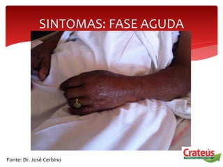SINTOMAS: FASE AGUDA
Fonte: Dr. José Cerbino
 
