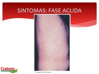 SINTOMAS: FASE AGUDA
 