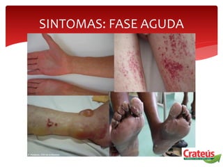 SINTOMAS: FASE AGUDA
 