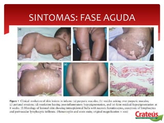 SINTOMAS: FASE AGUDA
 