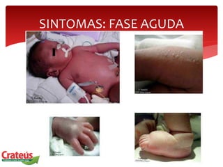 SINTOMAS: FASE AGUDA
 