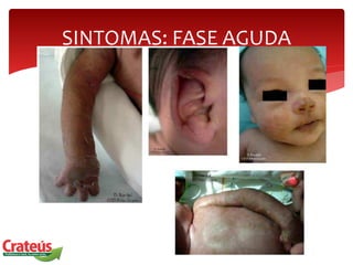 SINTOMAS: FASE AGUDA
 