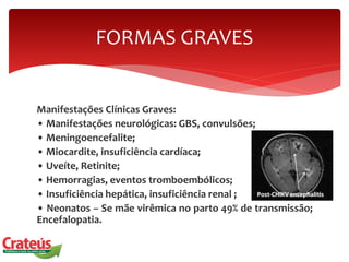 Manifestações Clínicas Graves:
• Manifestações neurológicas: GBS, convulsões;
• Meningoencefalite;
• Miocardite, insuficiência cardíaca;
• Uveíte, Retinite;
• Hemorragias, eventos tromboembólicos;
• Insuficiência hepática, insuficiência renal ;
• Neonatos – Se mãe virêmica no parto 49% de transmissão;
Encefalopatia.
FORMAS GRAVES
 