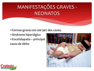 •Formas graves em até 90% dos casos;
•Síndrome hiperálgica
•Encefalopatia – principal
causa de óbito
MANIFESTAÇÕES GRAVES -
NEONATOS
 
