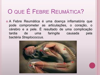 Febre reumática | PPTX