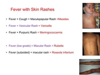 Fever with Skin Rashes
• Fever + Cough + Maculopapular Rash =Measles
• Fever + Vesicular Rash = Varicella
• Fever + Purpuric Rash = Meningococcemia
• Fever (low grade) + Macular Rash = Rubella
• Fever (subsided) + macular rash = Roseola infantum
 