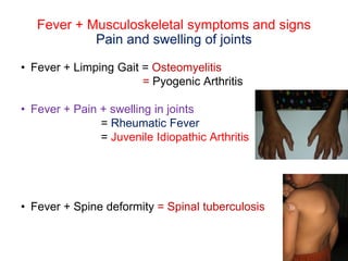 Fever + Musculoskeletal symptoms and signs
Pain and swelling of joints
• Fever + Limping Gait = Osteomyelitis
= Pyogenic Arthritis
• Fever + Pain + swelling in joints
= Rheumatic Fever
= Juvenile Idiopathic Arthritis
• Fever + Spine deformity = Spinal tuberculosis
 