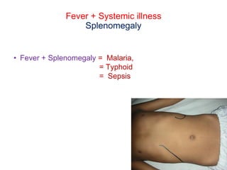 Fever + Systemic illness
Splenomegaly
• Fever + Splenomegaly = Malaria,
= Typhoid
= Sepsis
 