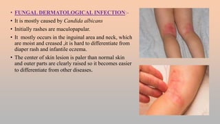 FEBRILE ILLNESS WITH SKIN RASHES.pptx