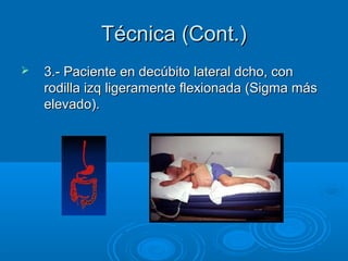 Técnica (Cont.)
   3.- Paciente en decúbito lateral dcho, con
    rodilla izq ligeramente flexionada (Sigma más
    elevado).
 