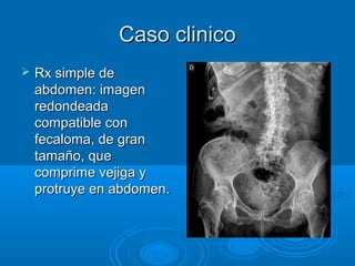 Caso clinico
   Rx simple de
    abdomen: imagen
    redondeada
    compatible con
    fecaloma, de gran
    tamaño, que
    comprime vejiga y
    protruye en abdomen.
 