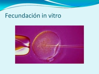 Fecundación in vitro
 