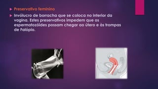  Preservativo feminino
 Invólucro de borracha que se coloca no interior da
vagina. Estes preservativos impedem que os
espermatozóides possam chegar ao útero e às trompas
de Falópio.
 