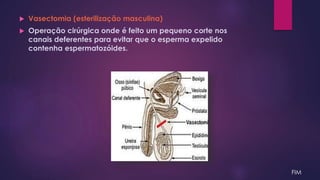  Vasectomia (esterilização masculina)
 Operação cirúrgica onde é feito um pequeno corte nos
canais deferentes para evitar que o esperma expelido
contenha espermatozóides.
FIM
 