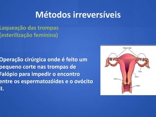 Métodos irreversíveis
Laqueação das trompas
(esterilização feminina)



Operação cirúrgica onde é feito um
pequeno corte nas trompas de
Falópio para impedir o encontro
entre os espermatozóides e o ovócito
II.
 