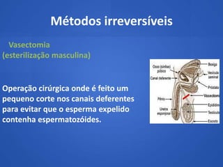 Métodos irreversíveis
  Vasectomia
(esterilização masculina)


Operação cirúrgica onde é feito um
pequeno corte nos canais deferentes
para evitar que o esperma expelido
contenha espermatozóides.
 
