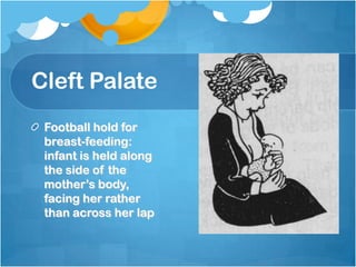 Cleft Palate
Football hold for
breast-feeding:
infant is held along
the side of the
mother’s body,
facing her rather
than across her lap
 