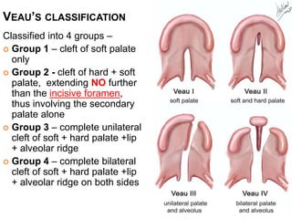 Veau Classfication Feeding plate for a newborn with Cleft Palate.pptx