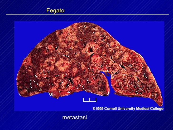Fegato Neoplasie Fegato Neoplasie