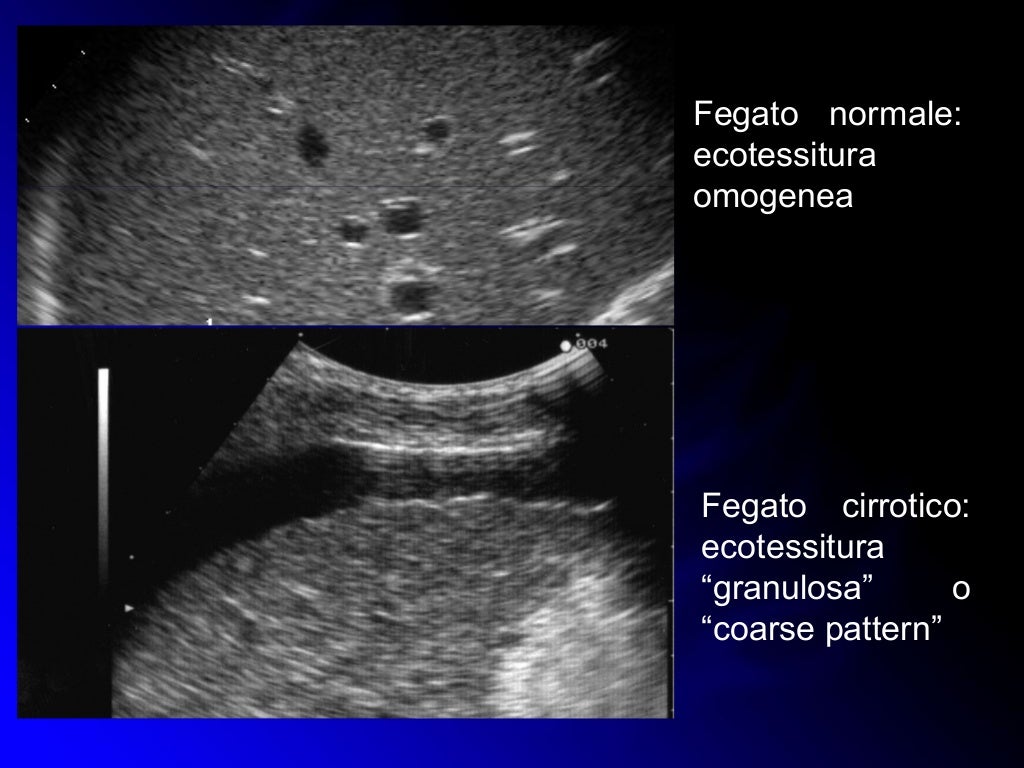 Ecocolordoppler Fegato E Vie Biliari Pompili M. Fegato (Anatomia e Patologia Diffusa) Colecisti e Vie Bili…