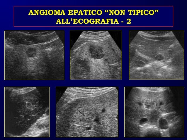 Caturelli E Fegato Patologia Focale Benigna Asmad 2016