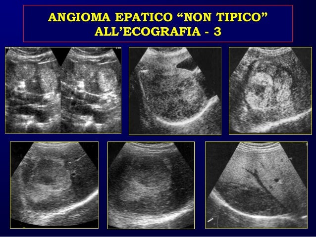 Caturelli E Fegato Patologia Focale Benigna Asmad 2016