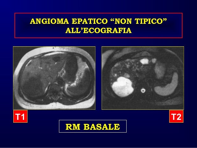 Caturelli E Fegato Patologia Focale Benigna Asmad 2016