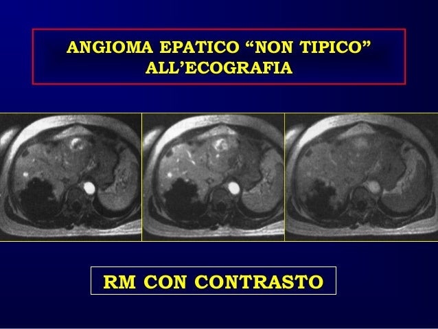 Caturelli E Fegato Patologia Focale Benigna Asmad 2016