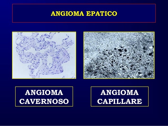 Caturelli E Fegato Patologia Focale Benigna Asmad 2016