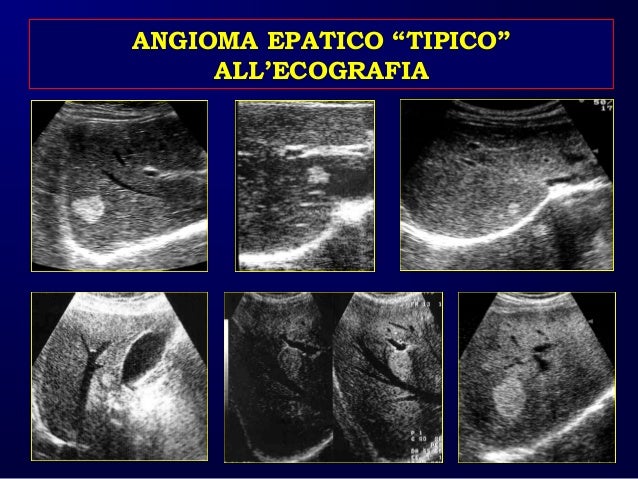 Caturelli E Fegato Patologia Focale Benigna Asmad 2016