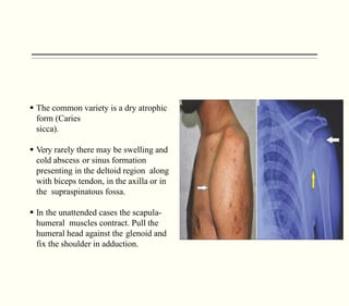 Tuberculosis of the skeletal system - surgical needs | PDF