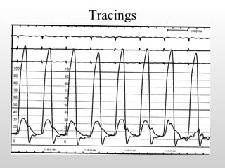 Tracings 