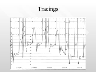 Tracings 