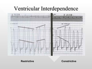 Ventricular Interdependence Restrictive   Constrictive   