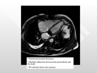 Normal pericardial thickness Multiple adhesions between the pericardium and the heart RV directly below the sternum 