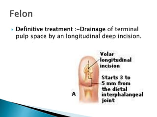 Incision Finger Pulp Felon Drainage