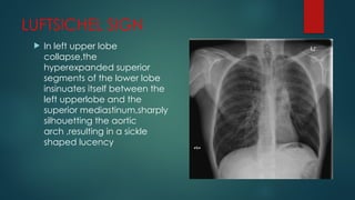 Luftcycle Sign felson's signs.pptx in chest radiography | PPTX