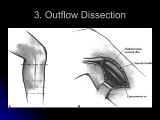 3. Outflow Dissection 
