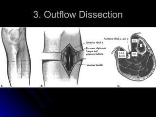 3. Outflow Dissection 