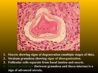 1. Oocyte showing signs of degeneration (multiple stages of this).
2. Stratum granulosa showing signs of disorganization.
3. Follicular cells separate from basal lamina and oocyte.
4. Glassy membrane (between granulosa and theca interna) is a
sign of advanced atresia.
 