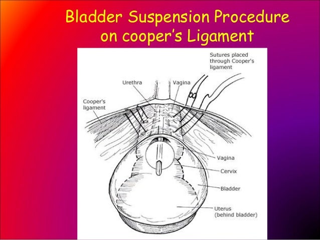 Why is bladder suspension surgery performed?